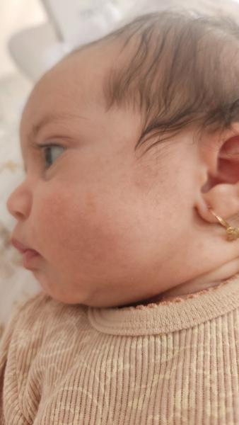 Sú to potničky alebo ekzém?