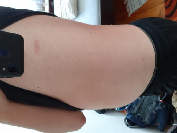 Môže to byť borelióza?