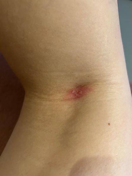 Je toto pásový opar počas tehotenstva?