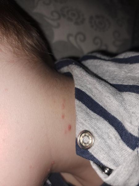 Sú to príznaky kiahní?