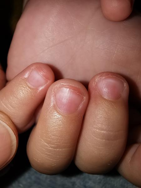 8 ročný hryzie bratovi nechty