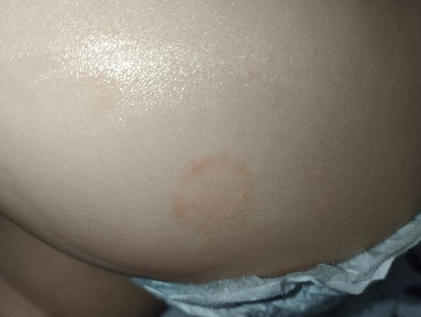 Kožný problém u 15-mesačného dieťatka