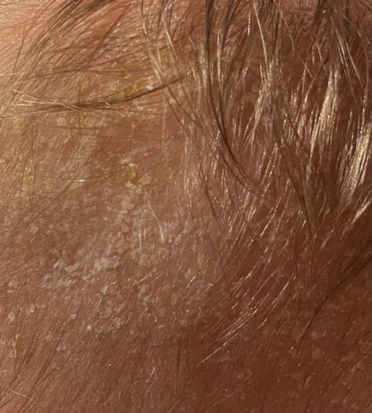 Ako odstrániť šupinky na hlave bábätka?