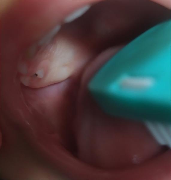 Mali takéto niečo vaše deti, keď sa im prerezávali zuby?