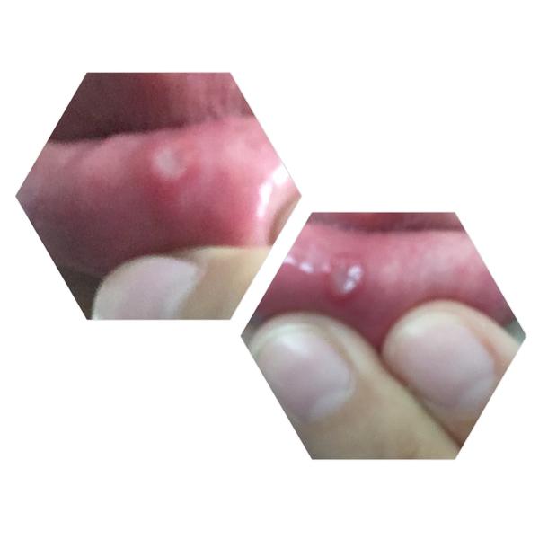 Ako liečite afty/ranky v ústach na ďasnách alebo na perách?