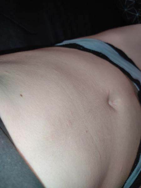 Aké červené fľaky mám na tele?