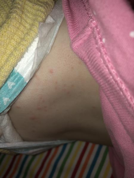 Atopický ekzém u 17 mesačnej a výsyp na tele