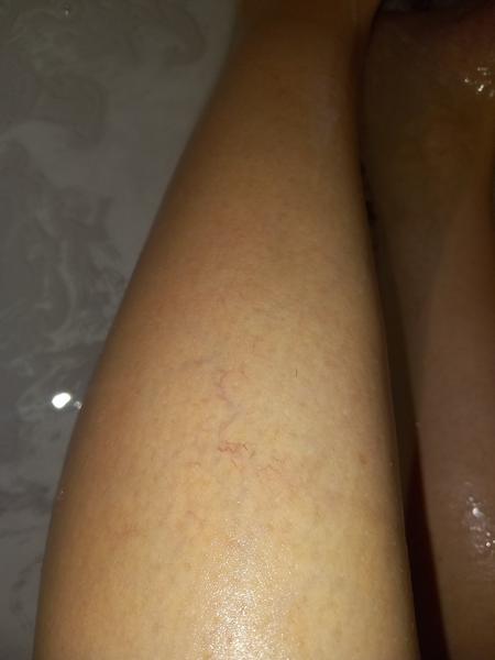 Je toto kŕčová žila?