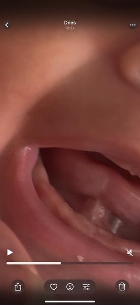 Príznaky rastu zúbkov u detí