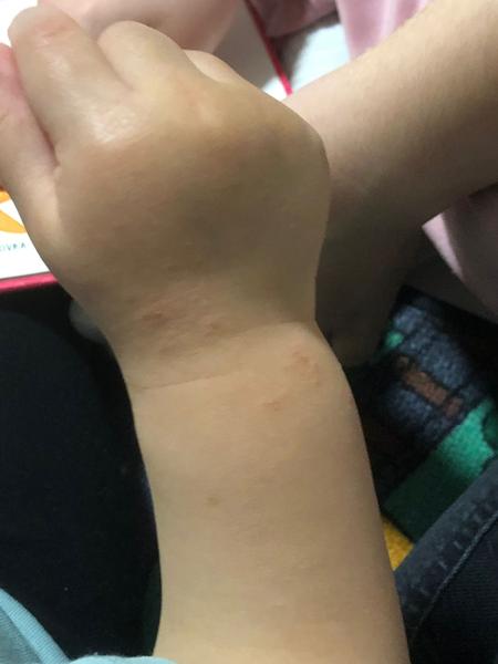 Môže mať 1,5-ročný syn intoleranciu i napriek tomu, že má výsledky v poriadku?