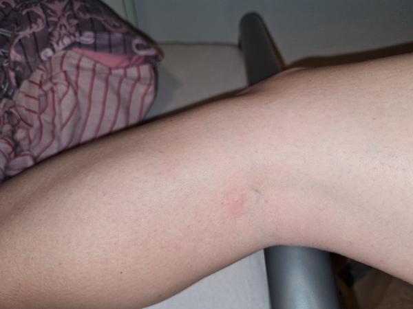 Kŕčová žila u 20-ročnej