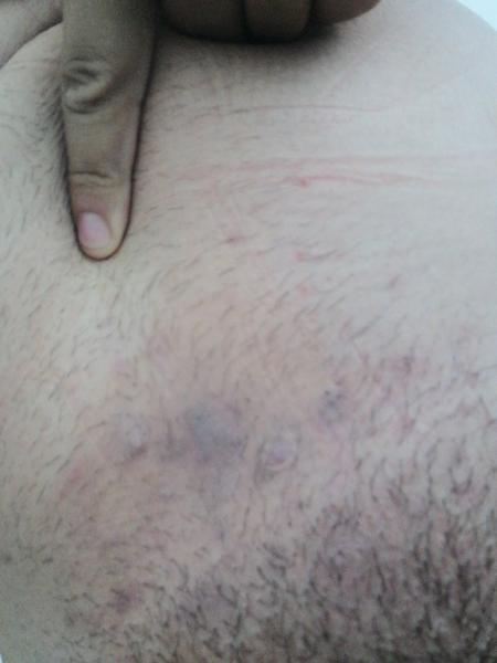 Čo na tmavé fľaky na pokožke?