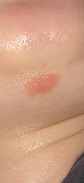 Červený fľak pod bradou