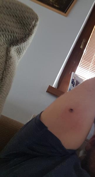 Bolestivá bradavica nad lakťom