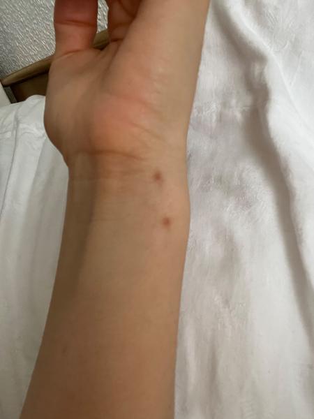 Aké hnedé škvrny sa mi vytvorili na zápästí?