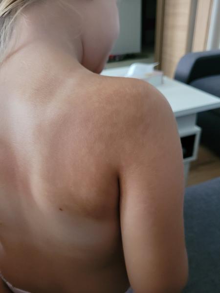 Má moja dcérka kožnú pleseň?