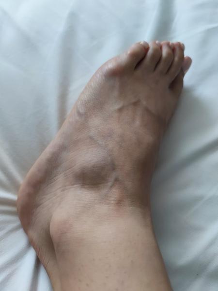 Ako správne zaobchádzať s vyvrtnutým členkom?