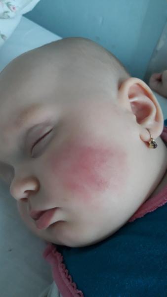 Červený fľak na jednom líčku