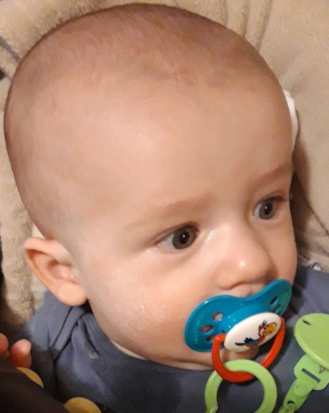 Atopický ekzém a krémy