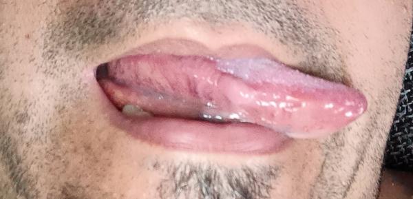 Čo je to za vred na jazyku?