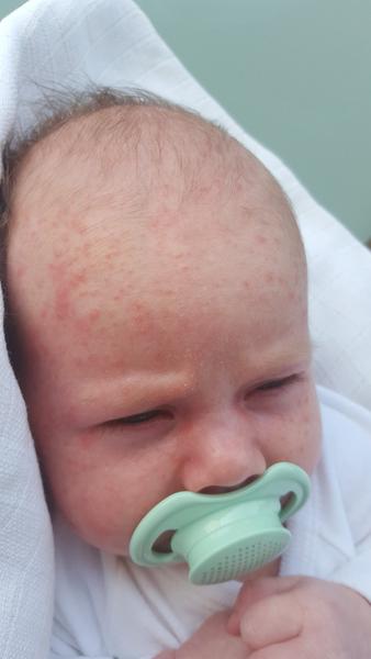 Poraďte čo to má na tváričke a dekolte?