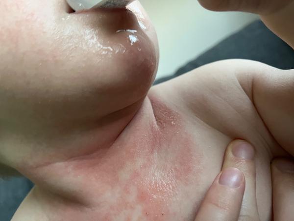 Ako môžem pomôcť 8-mesačnému synovi zjemniť vyrážky okolo krku?