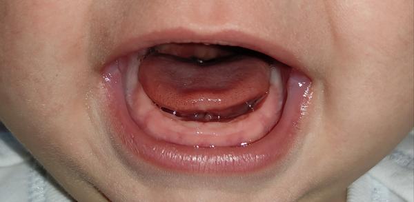 Tlačia sa môjmu dieťaťu zuby?