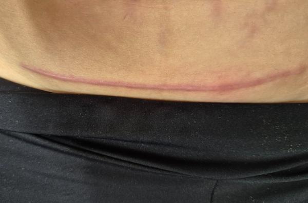 Má jazva po cisárskom reze vyzerať takto?