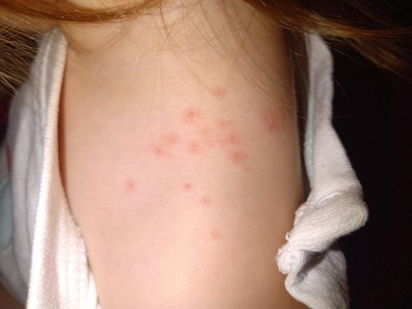 Čo sú toto za vyrážky u mojej dcérky?