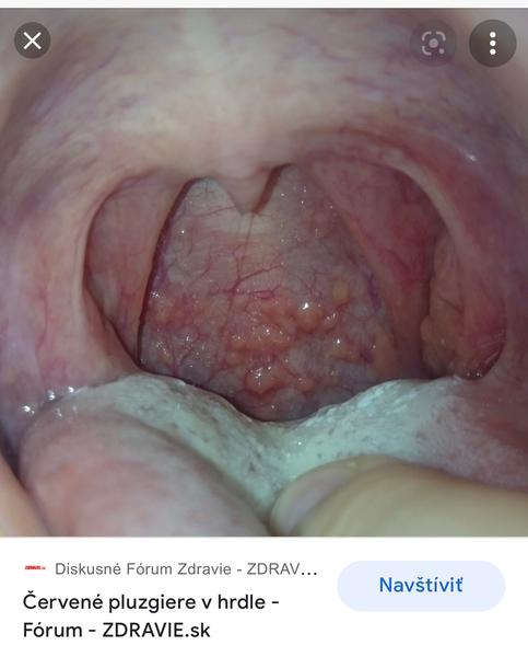 Čo znamenajú tieto pľuzgeriky v hrdle?