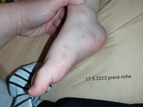 Fľaky na chodidlách