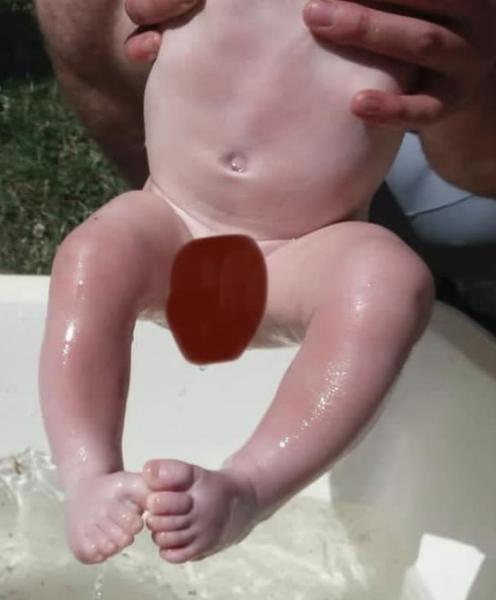 Je to diastáza u bábätka?