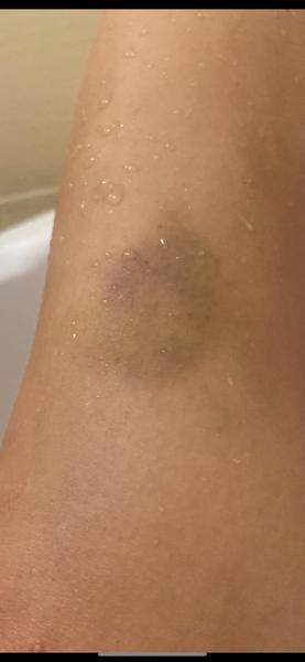 Čo s takými modrinami?