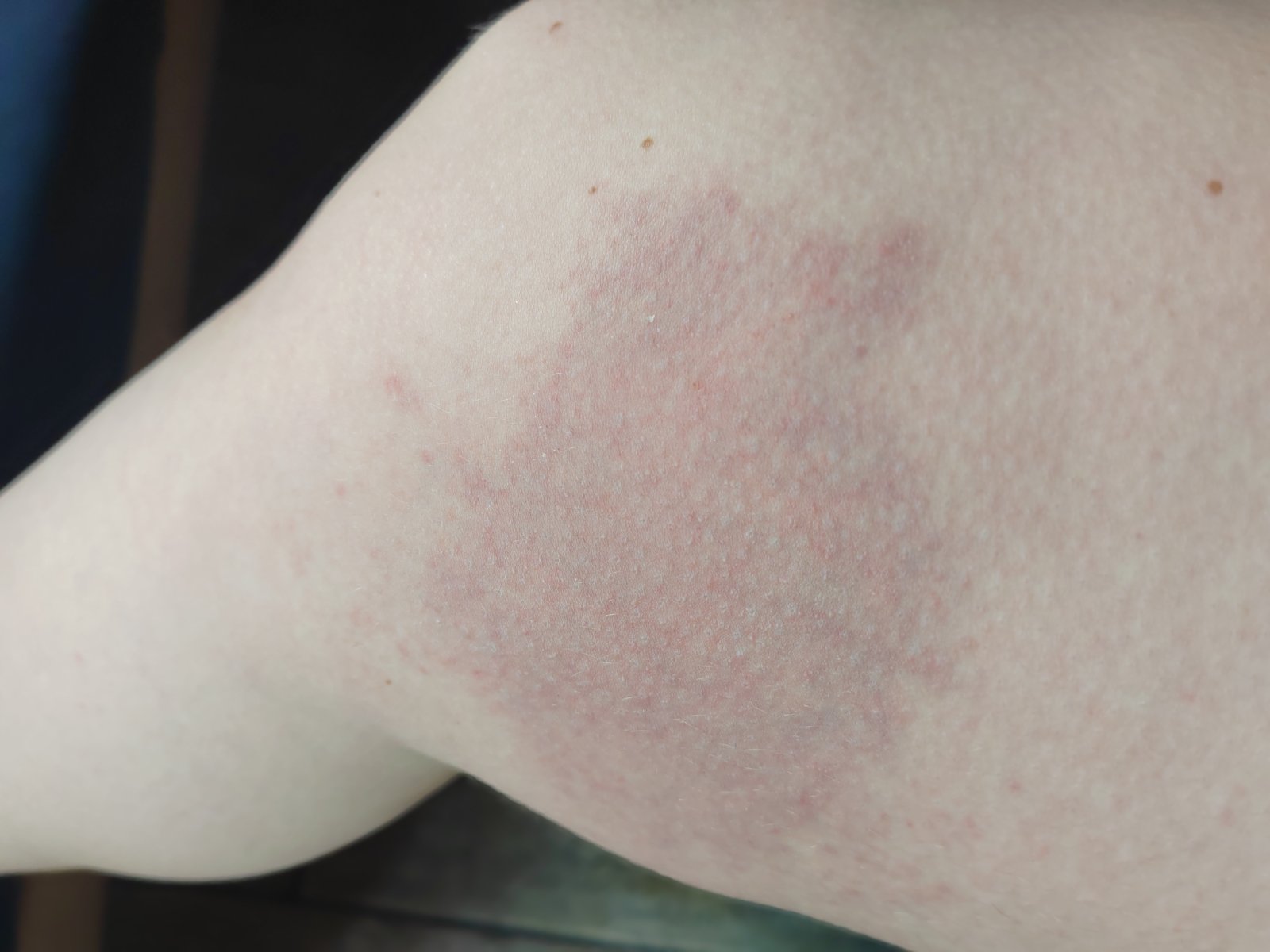 Opuch Uštipnutie osou: Ako liečiť opuch a bolesť? - Modrý koník