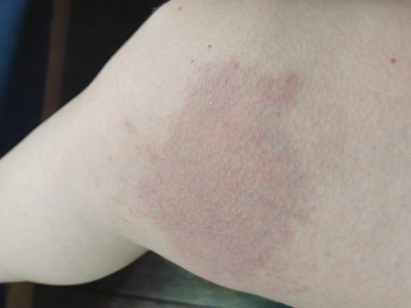 Uštipnutie osou: Ako liečiť opuch a bolesť?