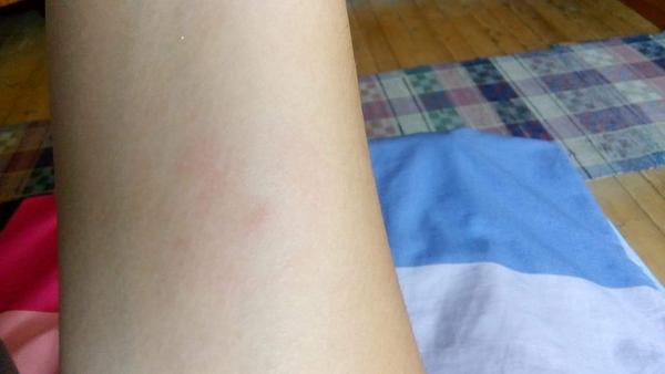 Myslíte, že mám boreliózu?