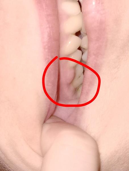 Čo znamená útvar na ďasne medzi zubami?