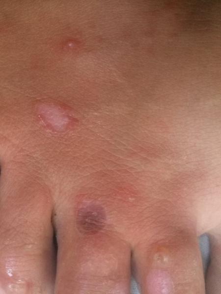 Pľuzgiere na narazenom palci