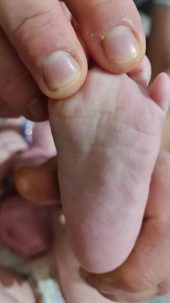 Je to kurie oko či ovčie kiahne?