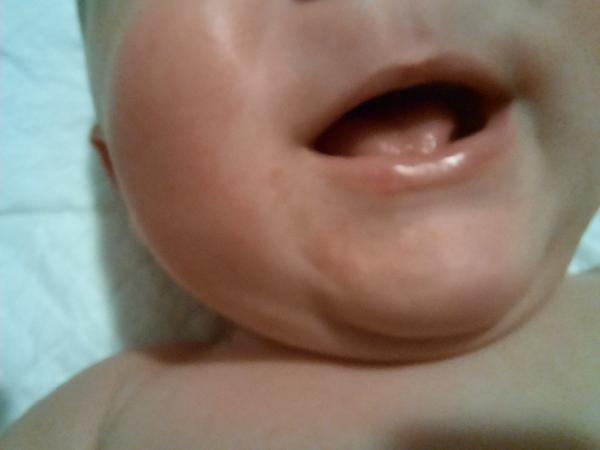 Vyrážky na tvári bábätka: Kedy navštíviť lekára?