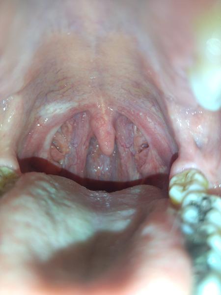 Ako liečiť hnisavé mandle?