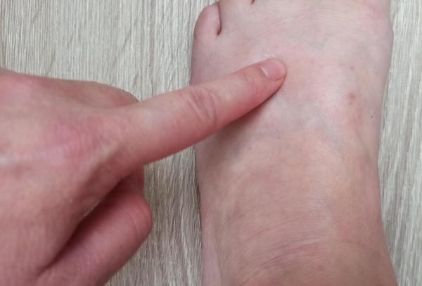 Opuch a nemožnosť ohnúť prsty