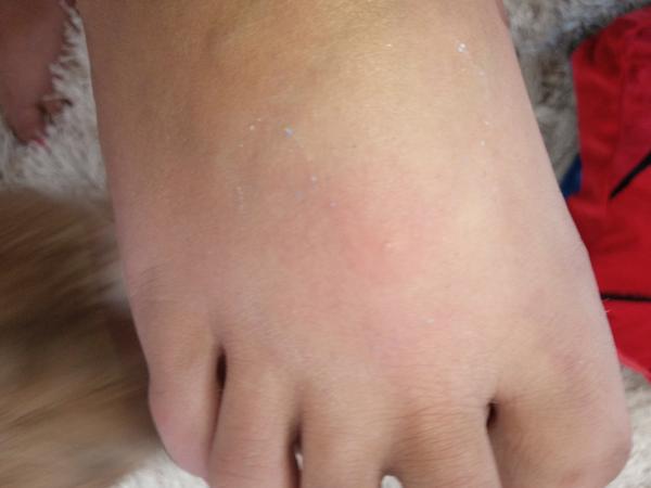 Čo ma mohlo poštípať?