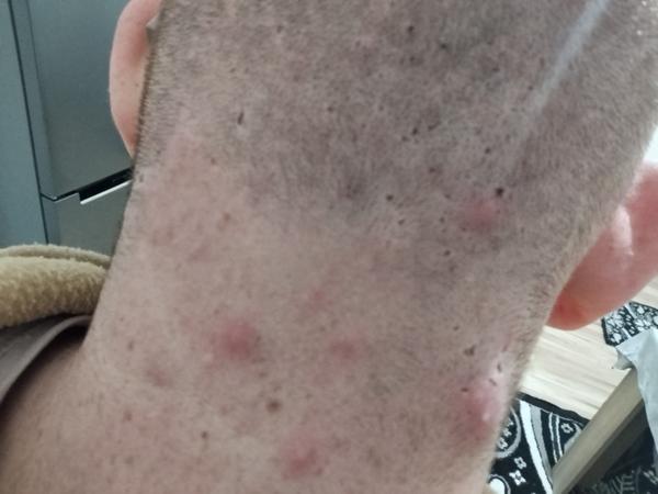 Môžem ísť na pohotovosť so silnou kožnou bolesťou?