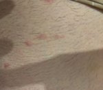 Dlhotrvajúce svrbenie a vyrážky