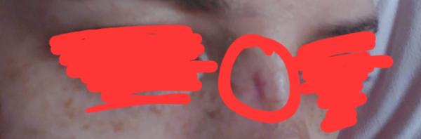 Zmizne mi priehlbinka po rhinoplastike?