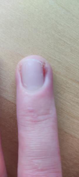 Ako liečiť zápal nechtového lôžka?