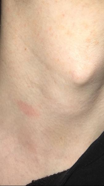 Prečo mávam bodavú bolesť na krku?