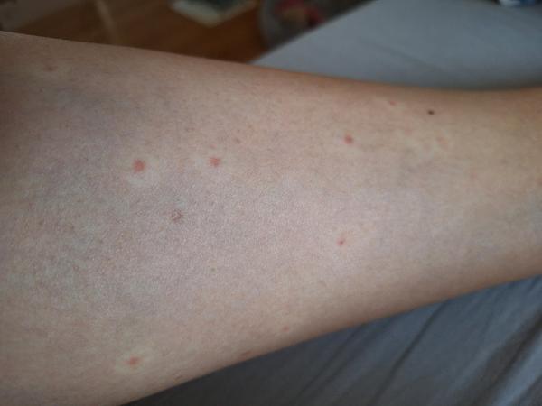 Je to od blchy alebo ploštice?