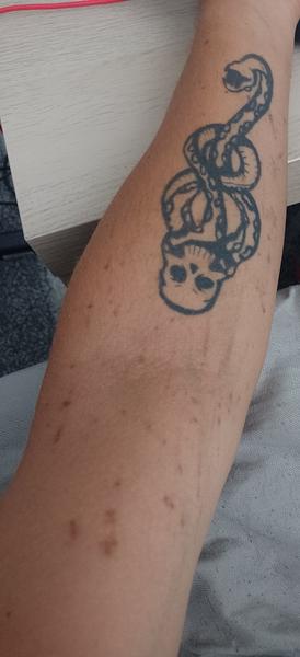 Čo znamenajú tieto vyrážky na rukách?